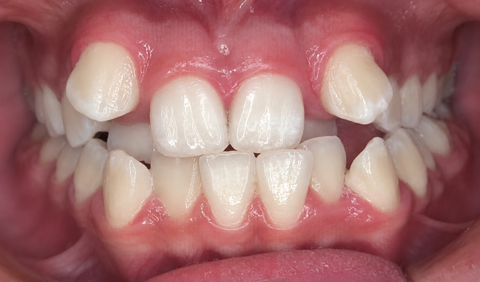Foto intraoral antes do tratamento ortodôntico — caso 1