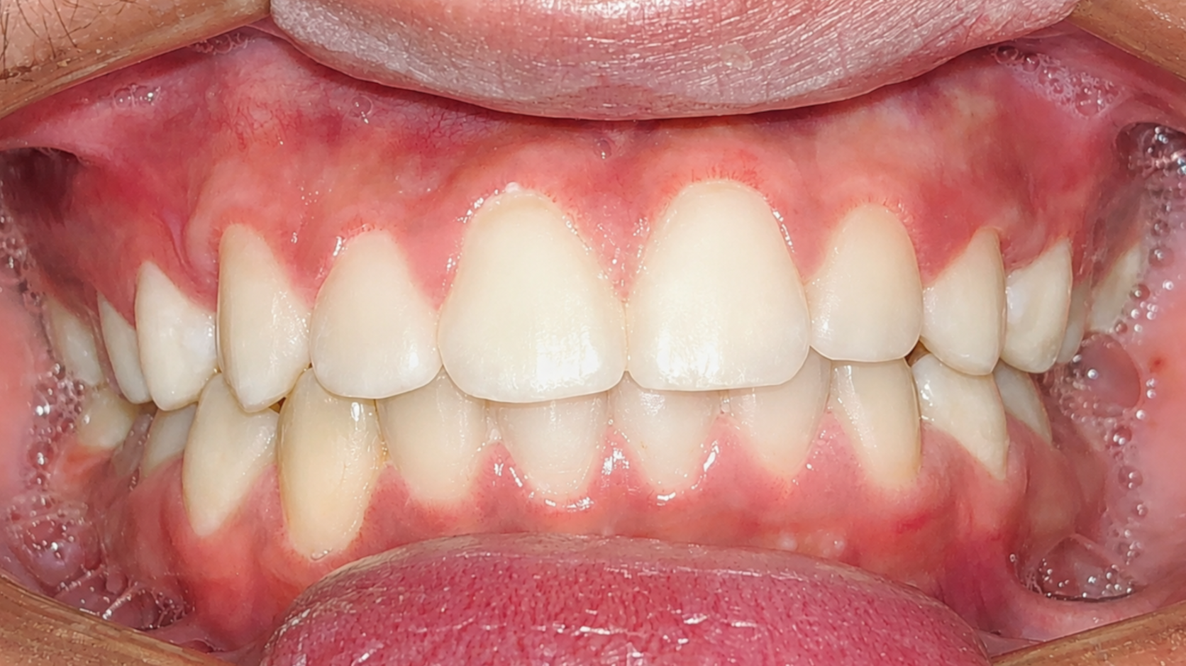 Foto intraoral depois do tratamento ortodôntico — caso 3