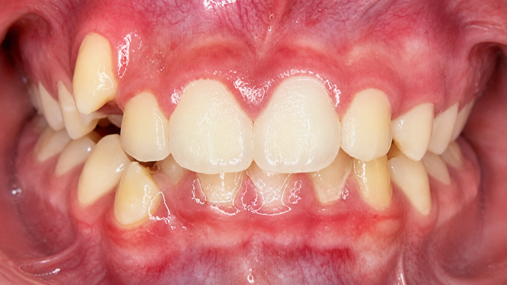 Foto intraoral antes do tratamento ortodôntico — caso 3