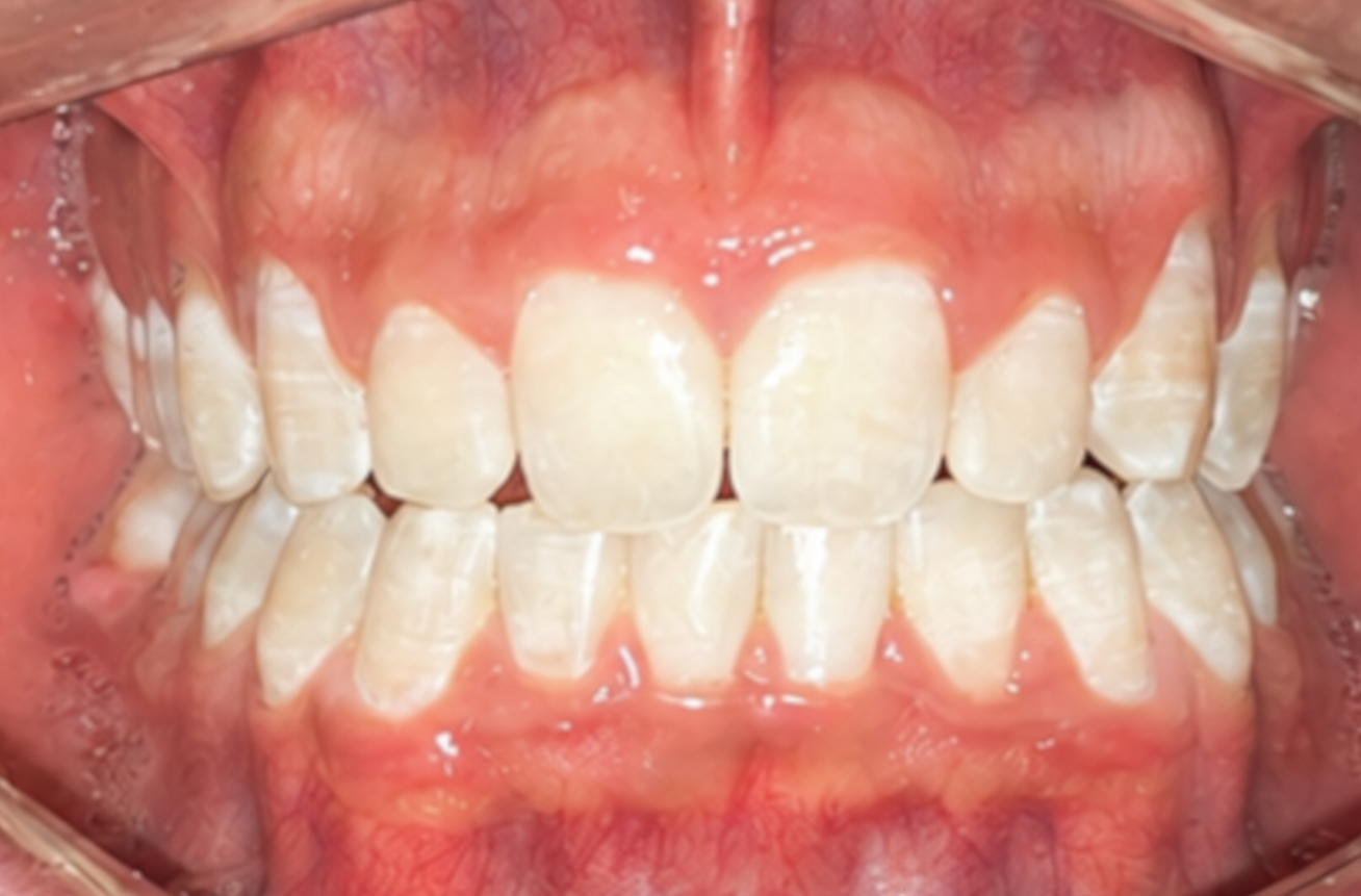 Foto intraoral depois do tratamento ortodôntico — caso 2