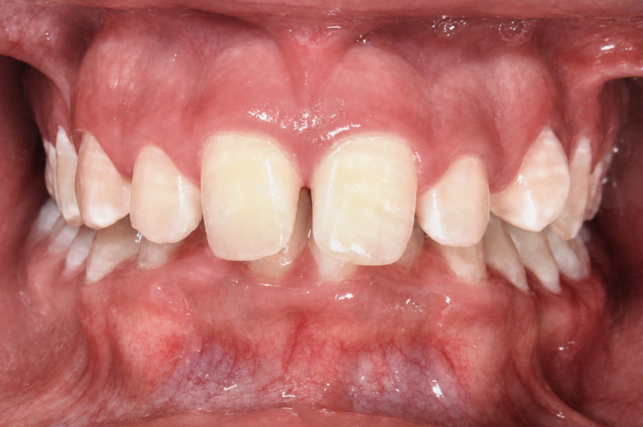Foto intraoral antes do tratamento ortodôntico — caso 2